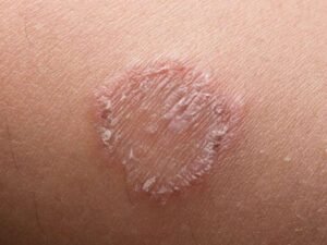 Read more about the article Ringworm: Causes, Symptoms, and How to Get Rid of It For Good