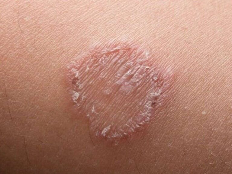 Read more about the article Ringworm: Causes, Symptoms, and How to Get Rid of It For Good